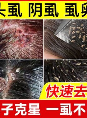 除骚子药灭虱子跳蚤药小孩头上长虱子药女孩头发上有狮子药水儿童