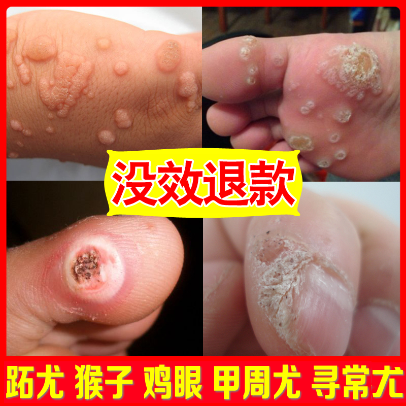 去刺猴正品猴子疙瘩肉里鸡眼老茧肉刺祛尤跖疣瘊子血胞刺专用膏