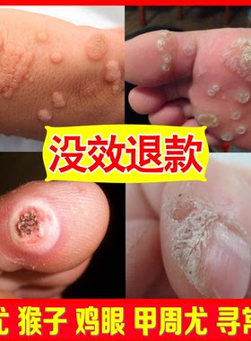 瘊子跖疣甲周疣丝状疣