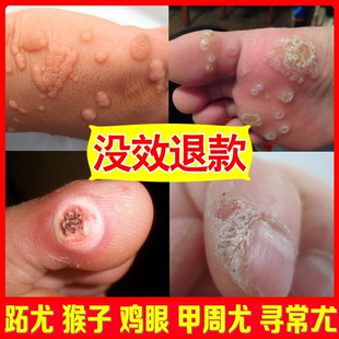 去刺猴正品猴子疙瘩肉里鸡眼老茧肉刺祛尤跖疣瘊子血胞刺专用膏