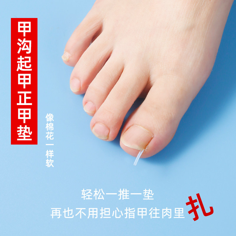 甲沟矫正器贴片炎嵌甲神器防脚指