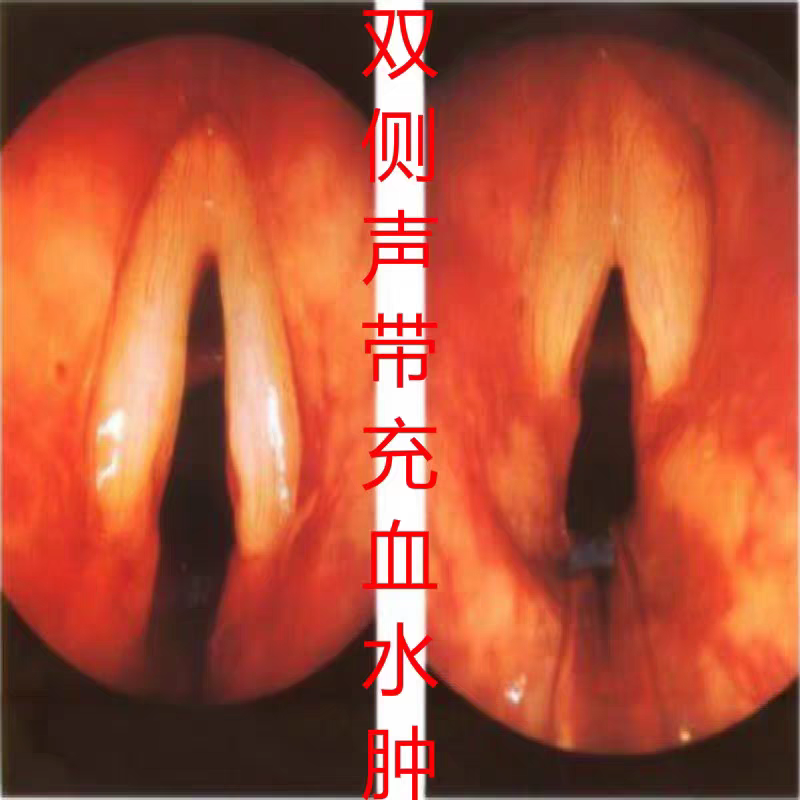 声带充血水肿声音沙哑说话费劲咽痛咽干咽痒任克氏炎肥厚小结肥厚