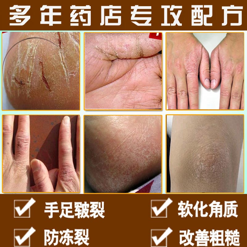 抑菌手足藓清雨坊瘙痒脱皮