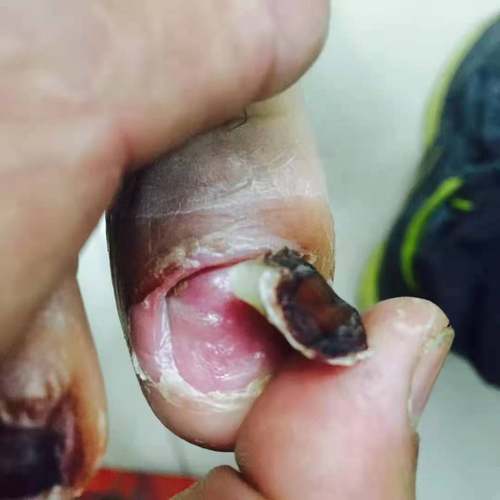 修脚店专用脱甲膏包甲