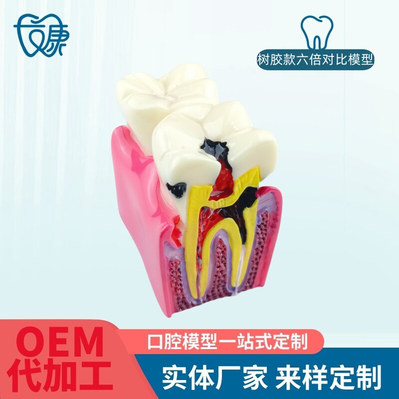 牙科双侧龋齿对比模型讲解沟通教学饰品摆件模型齿科口腔材料 - 实物图