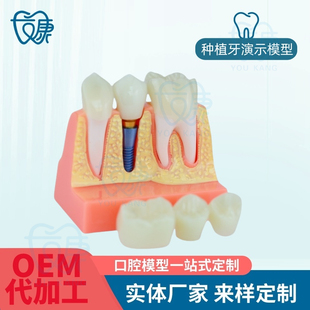 种植牙 4倍种植解模型 义齿修复种植牙解说 可拆卸 连桥牙冠
