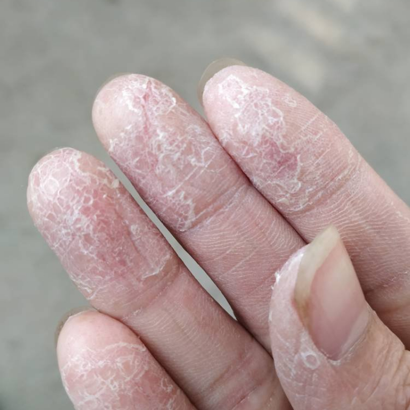 手上长水泡痒膏手指上起脱皮手掌干裂皮肤痒过敏水泡手痒止痒脱皮