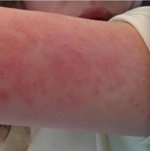 湿毒清夏季皮肤日晒水泡日光紫外线皮肤痒抑清洁修复性过软膏敏