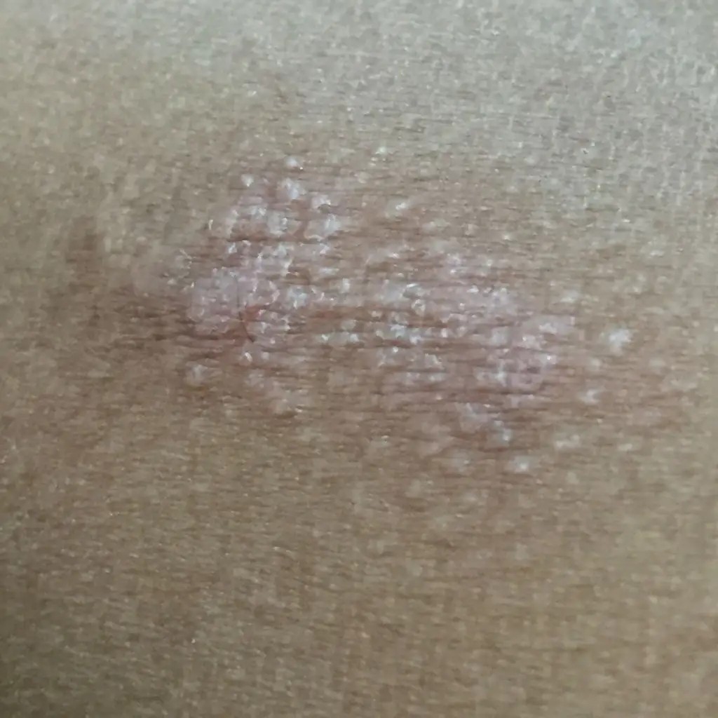 偏方土方止痒湿大腿根部内侧红斑瘙痒痘痘红诊藓手脱皮干裂肤适康