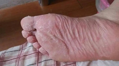 治脚指头止痒脱皮抑菌治脚痒脱皮烂脚丫脚上长水泡痒脚趾缝开裂烂