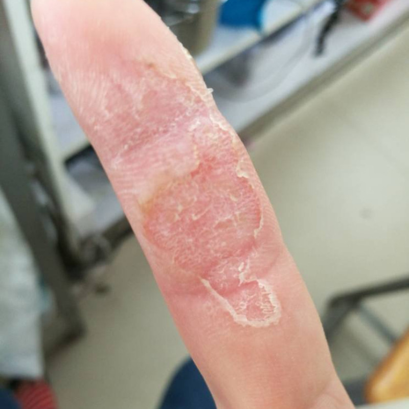 脚底上起小水泡又痒又脱皮去儿童脚掉皮烂脚丫根水疱型脚气杀菌膏