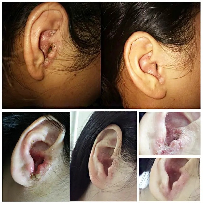 人用中耳外耳道红专用痒滴耳液流水流脓采耳油耳朵痒耳药软膏炎