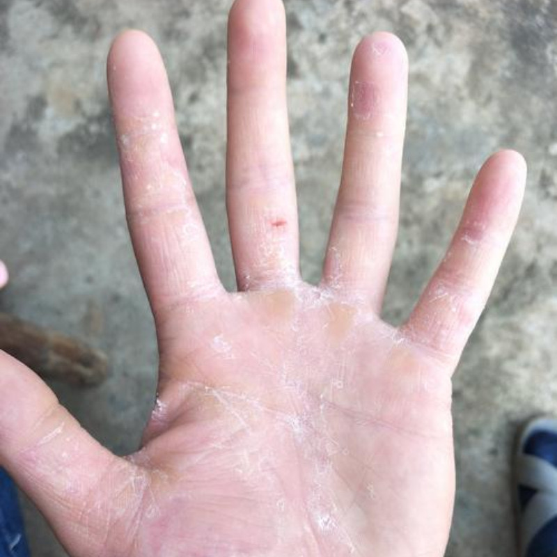 手脱皮严重脱皮专用真菌脚痒蜕皮干燥起皮手干裂手指脱皮抑菌感染