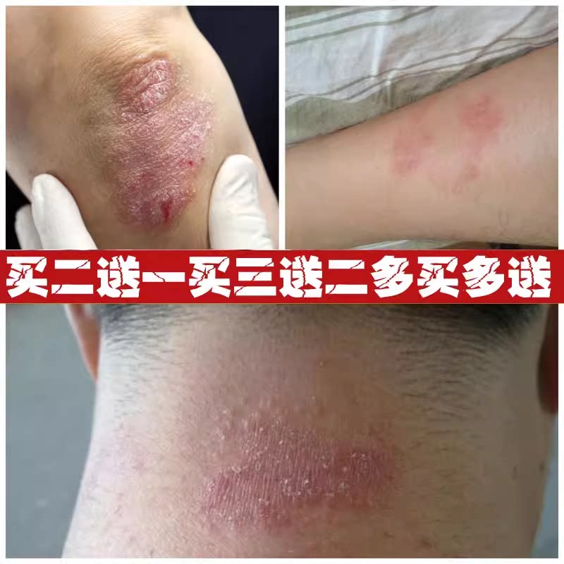 皮康王屁股痒手脚大腿内侧痒阴囊私处肛门瘙杀抑止乳膏菌手脱皮
