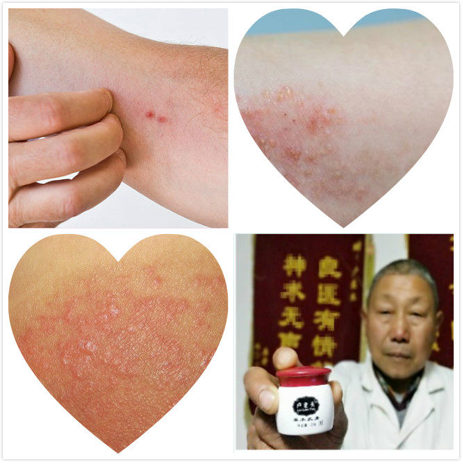 紫外线过敏药专用膏太阳晒伤胳膊日光性皮炎起小疙瘩皮肤瘙痒修复