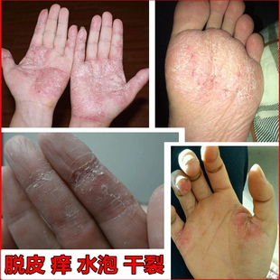 手上起小水泡手鲜手痒水泡脱皮干裂止痒膏手气反复药手脱皮季节性
