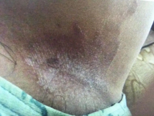 膏正品菌外用皮肤瘙痒止痒抑菌藓胯下男士私处大腿内侧根部