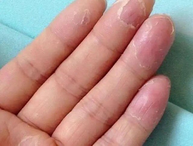 手痒小水泡手指脚底脚手脱皮严重干裂手足开裂去死皮手脚