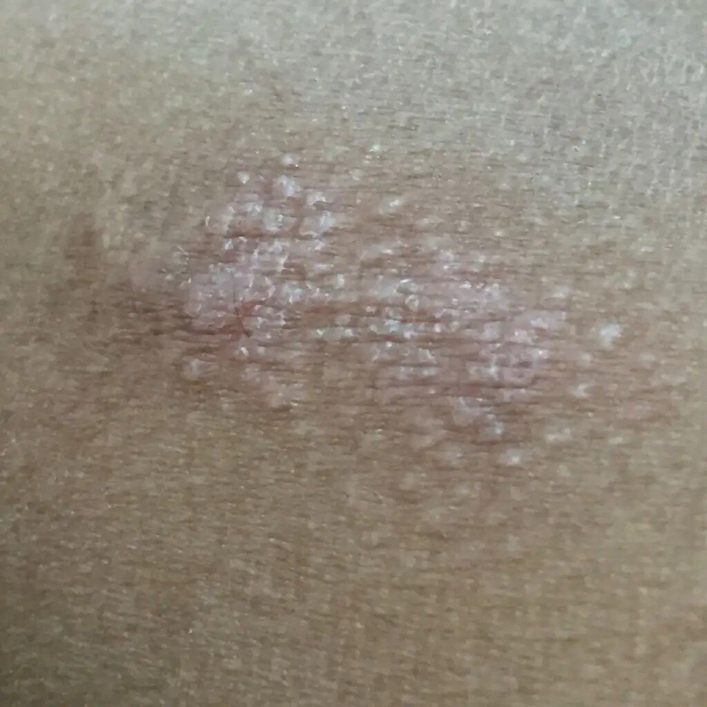 大腿内侧根部阴囊潮湿去潮湿女肛门潮湿屁眼痒男士私处抑手菌皮肤