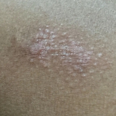 大腿内侧根部阴囊潮湿去潮湿女肛门潮湿屁眼痒男士私处抑手菌皮肤