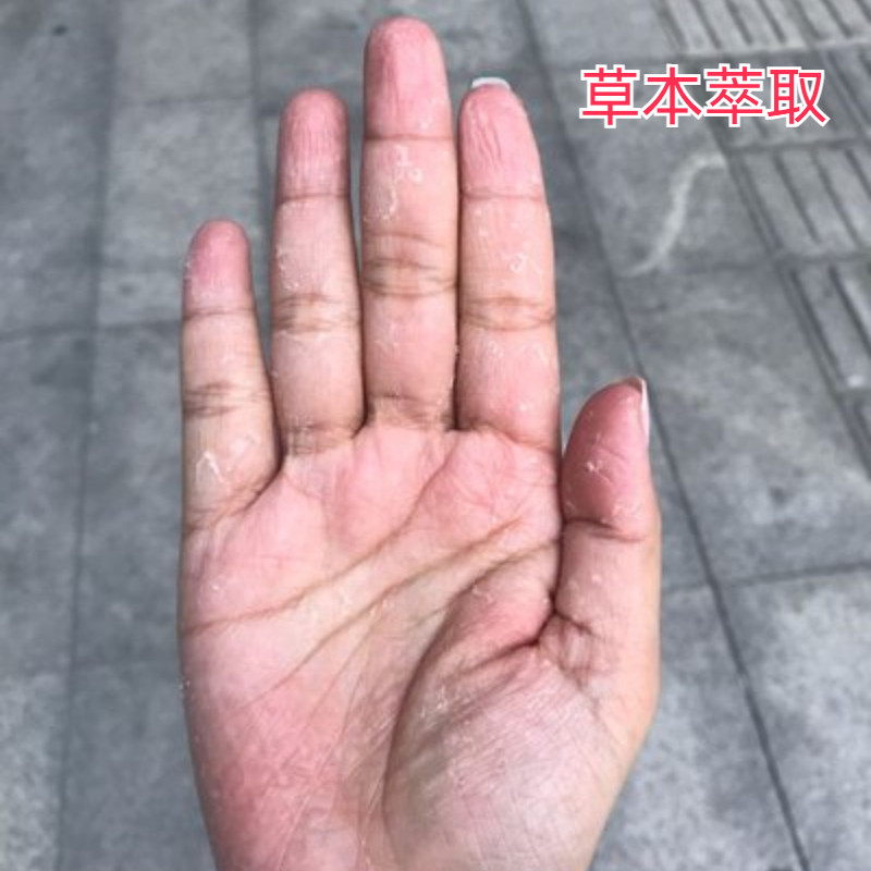 手脚上起水泡痒皮鲜脚痒手气止痒脱皮干裂杀菌汗孢疹膏药
