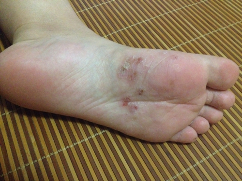 脚趾头小拇指发红烂了小会手脚痒干裂脱皮小水泡手丫去脚裂缝止痒