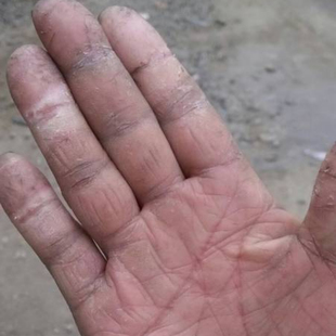 手指头裂口子干裂修复护手霜开裂脱皮裂开手足开口手脚冬季皲裂膏