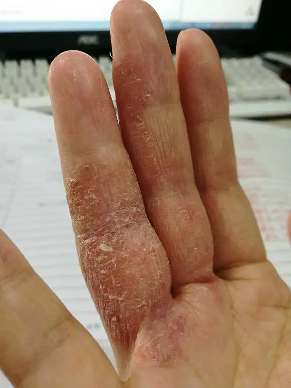 上长水泡脚后跟起皮治烂开裂干燥