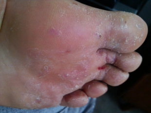 草本手痒是手脚脱皮脚丫水泡脚趾缝开裂脚底板皮肤手脱皮痒膏