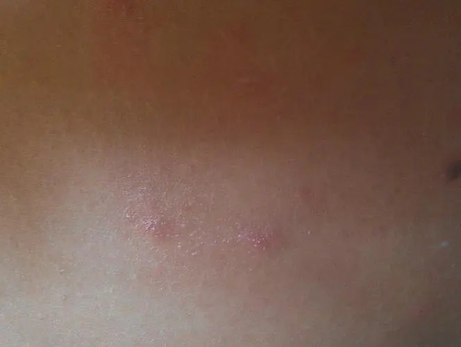 大腿内侧痒大腿根痛股沟红起小疙瘩发红大腿根发黑舒缓软膏清洁