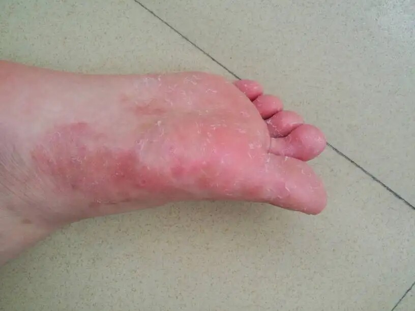 手脚开裂干裂干燥脱皮掉皮修复霜季节性手起水泡手部护理去死皮膏