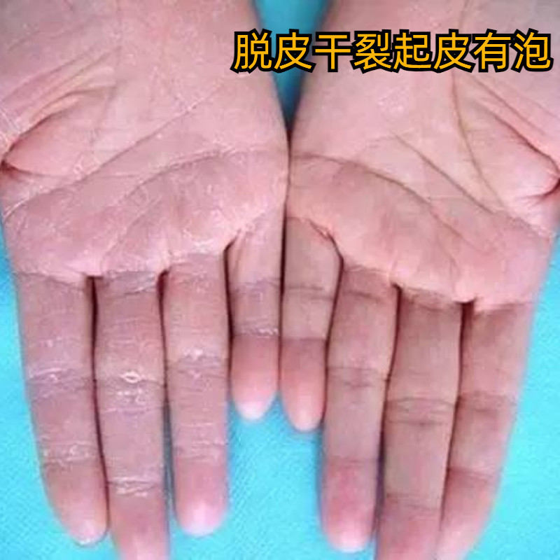手脱皮修复霜膏季节性手掌手指干裂手上起皮干燥掉皮足脚严重专用