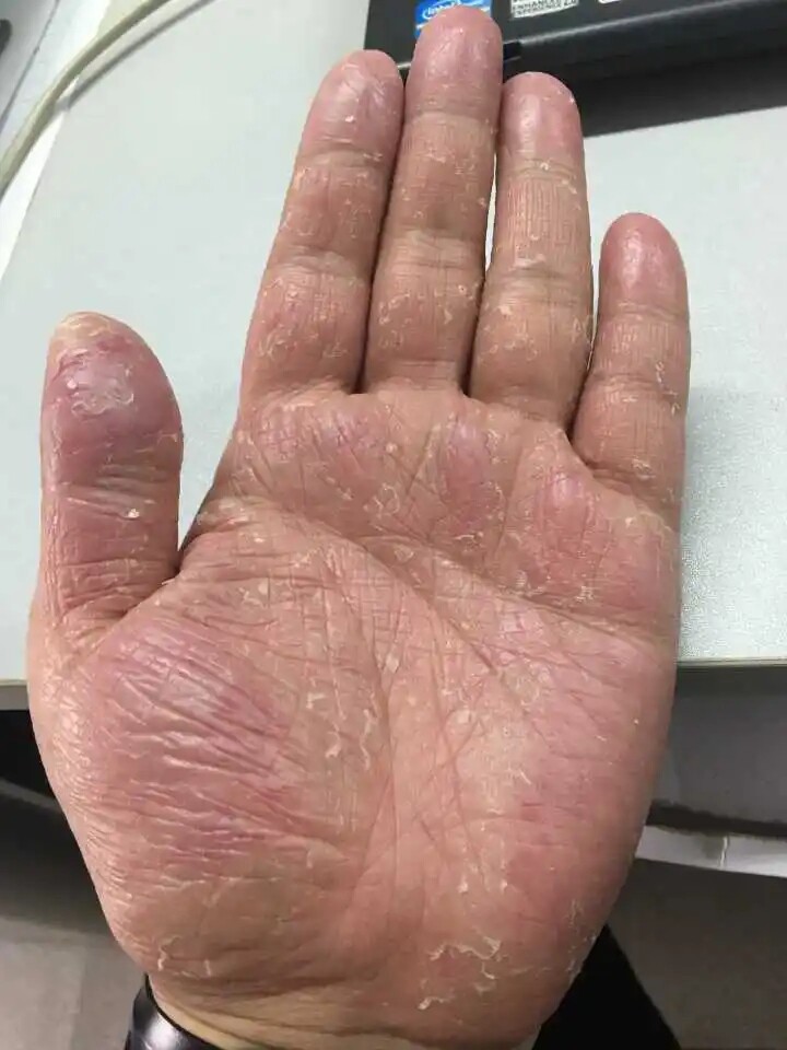 手脱皮的药膏脚蜕皮手掌手指皲裂手上起皮干燥干裂口季节性修复霜