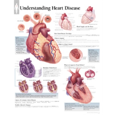 预订不退不换Understanding Heart Disease Laminated Poster[9781930633469]