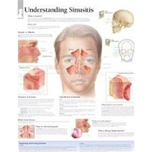 预订不退不换Understanding Sinusitis Paper Poster