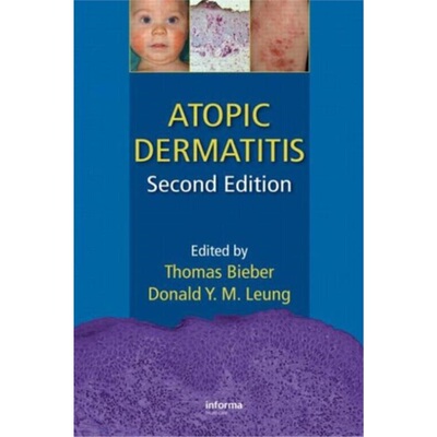 预订Atopic Dermatitis[9781420077988]