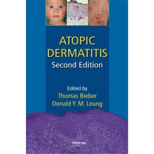 预订不退不换Atopic Dermatitis[9781420077988]