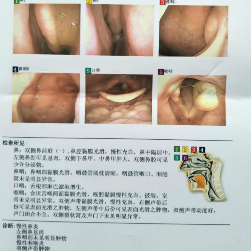 声带肿物接触性芽肿息肉肥厚小结水肿声音沙嘶哑慢性