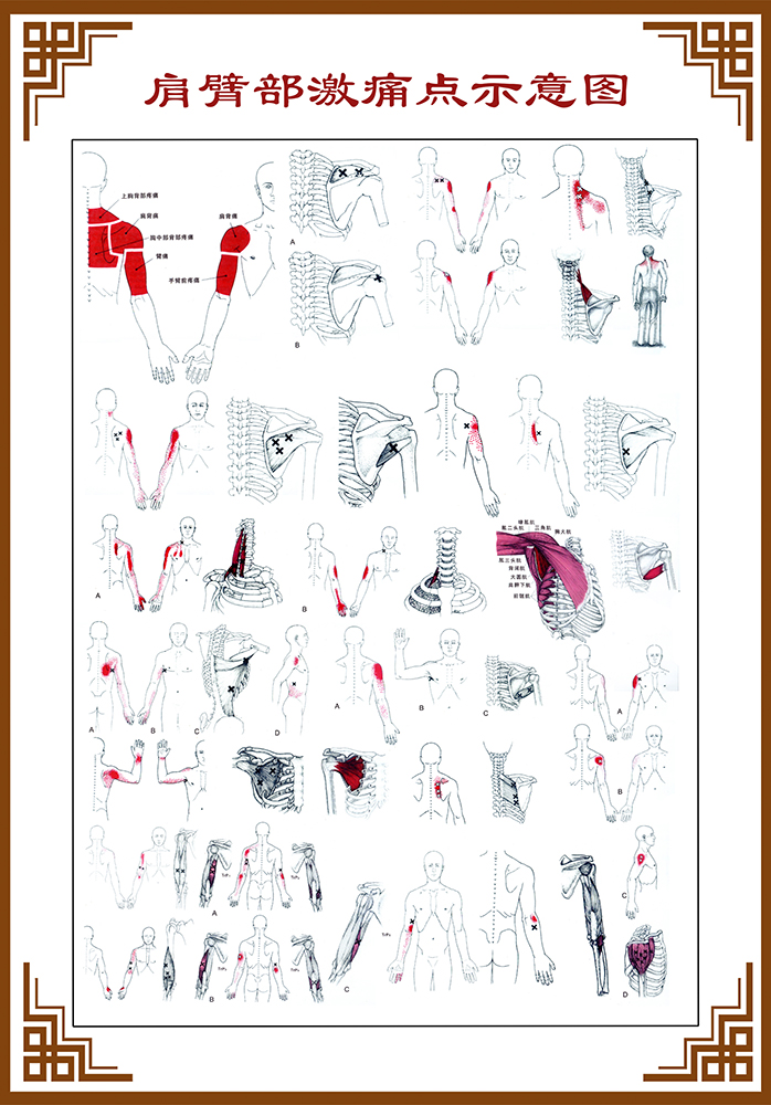 m768肩臂部激痛点示意图医院养生馆宣传贴画1102展板喷绘海报印制