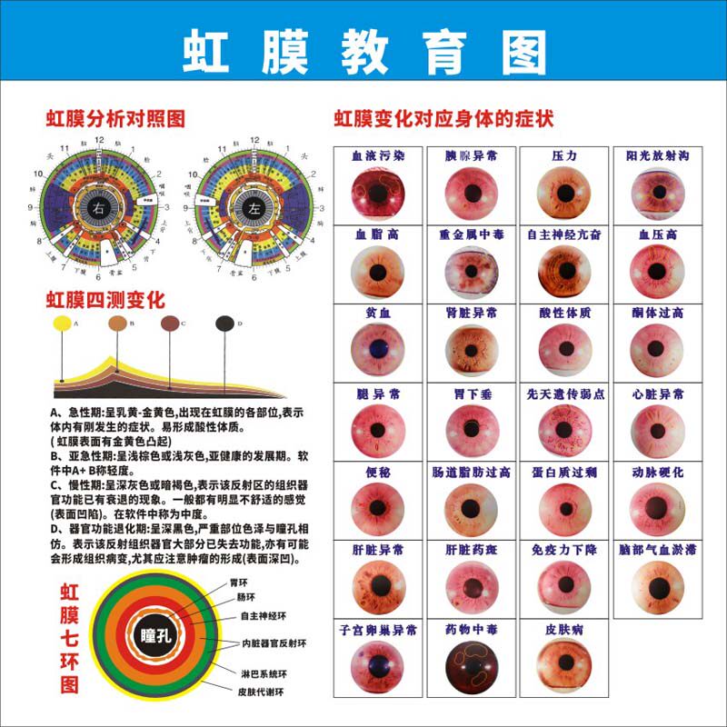 m769虹膜分析对照图四测变化七环图对应身体变化海报印制展板2269