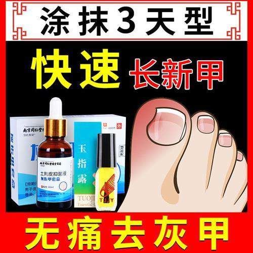 快速无痛灰指甲抑菌液祛