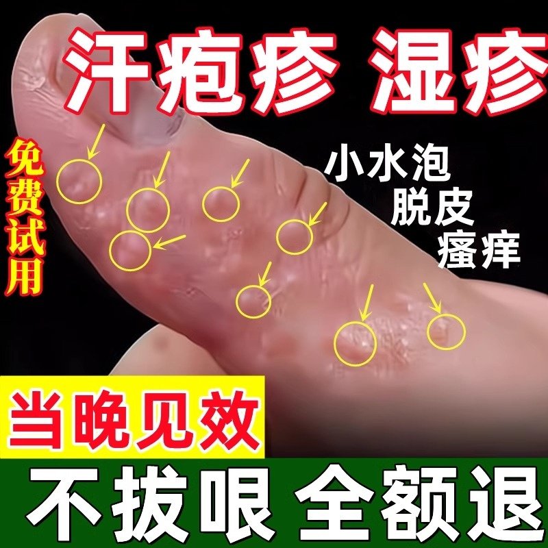 汗泡疱疹药膏汉状真菌感染手气膏手上起小水泡手痒干裂脱皮专用膏_虎窝淘
