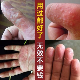 手上长水水泡痒汗疹膏疱手指起小水泡脱皮皮肤过敏手痒