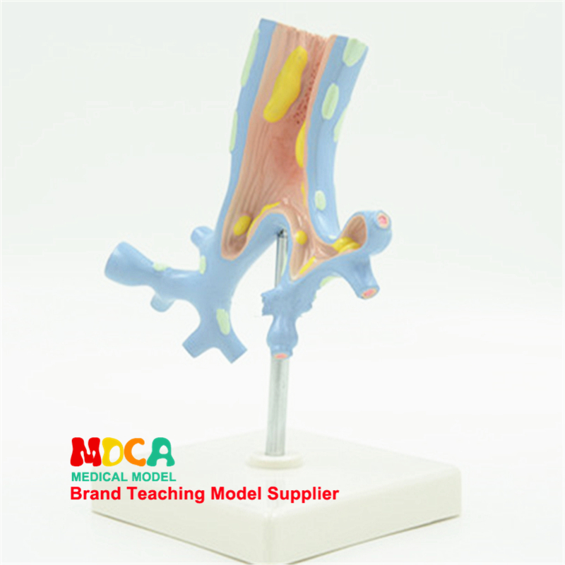 病理病变支气管炎解剖模型道具