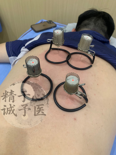 温针灸防落灰器，温针灸无烟艾灸器温针灸夹紧器温针灸防烫工具