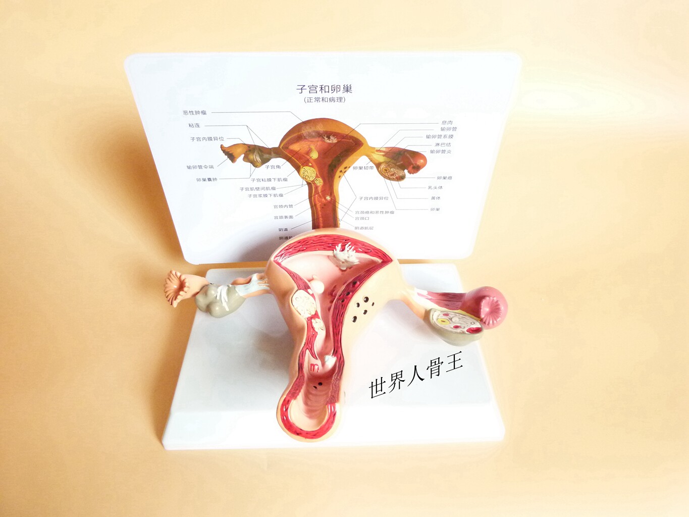 子宫、卵巢病理病变模型 生殖科