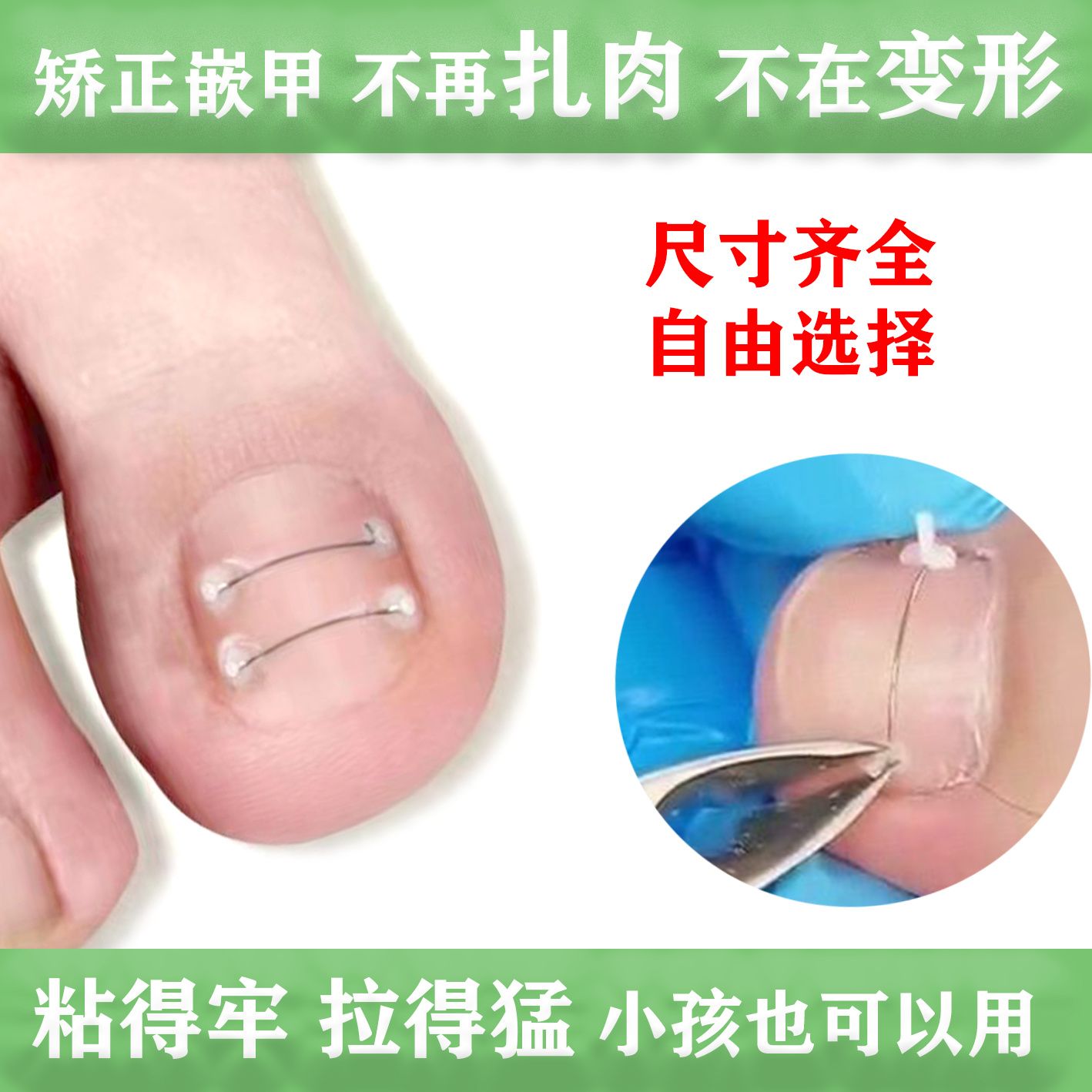 新款嵌甲矫正钢丝贴片甲沟趾甲扎肉里矫正贴记忆弹力金属矫正丝