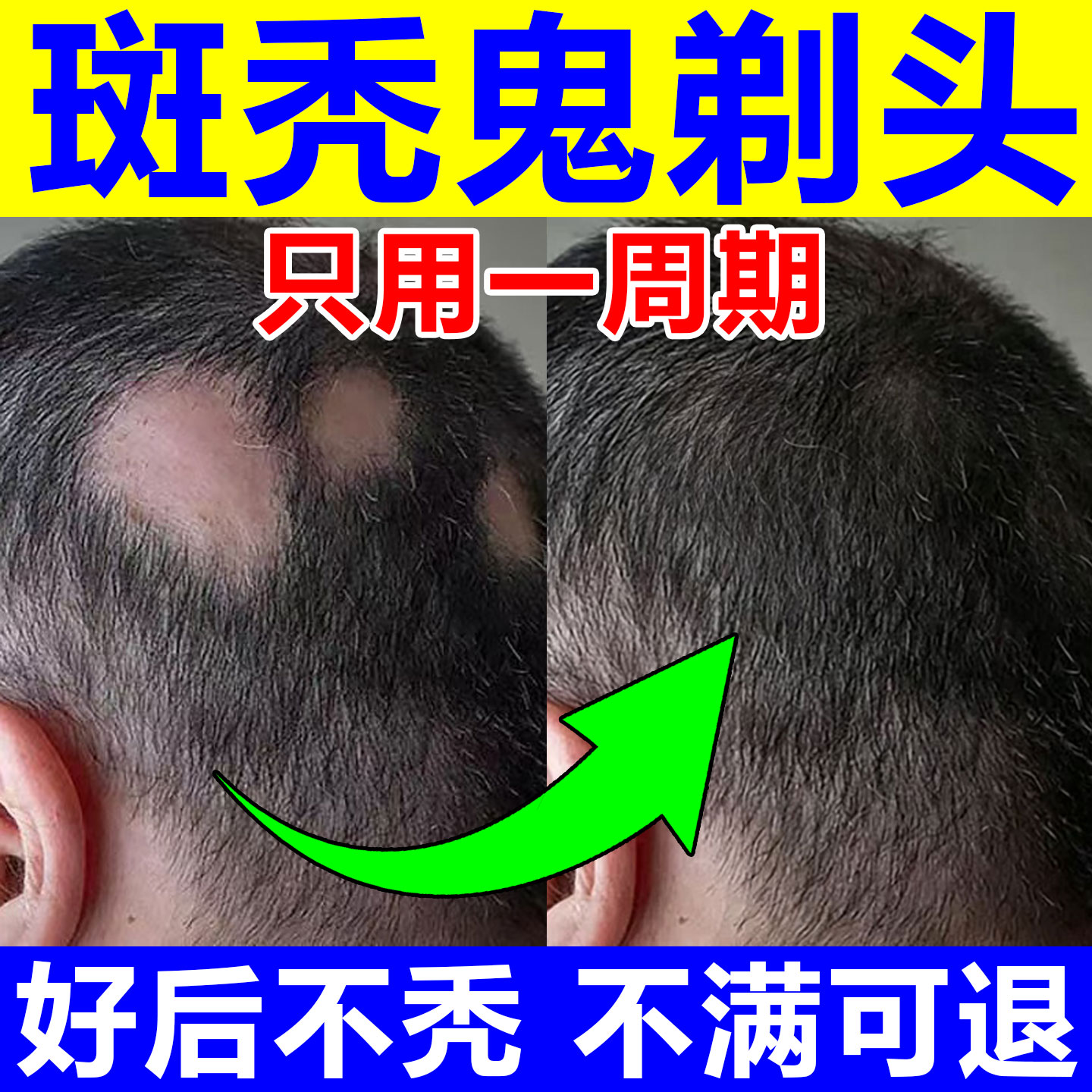 斑秃特鬼剃头效防严重脱发专用中药激活毛囊一抹灵遮盖神器生发液
