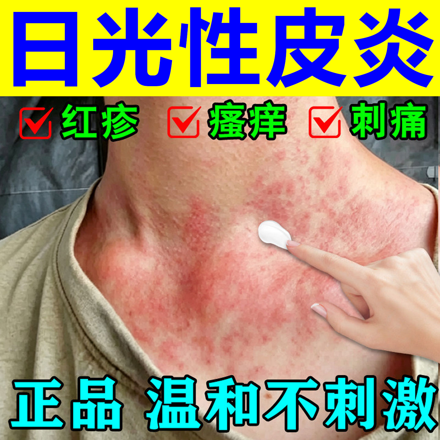 紫外线过敏专用药膏太阳晒伤皮肤修复脸部脖子发痒红脱皮急救专用
