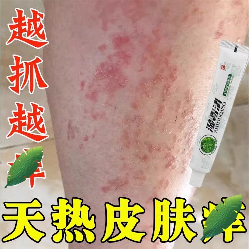 夏天小腿痒湿成人止膏出汗身上痒天热瘙皮肤疹痒热疙瘩红疹热毒痒